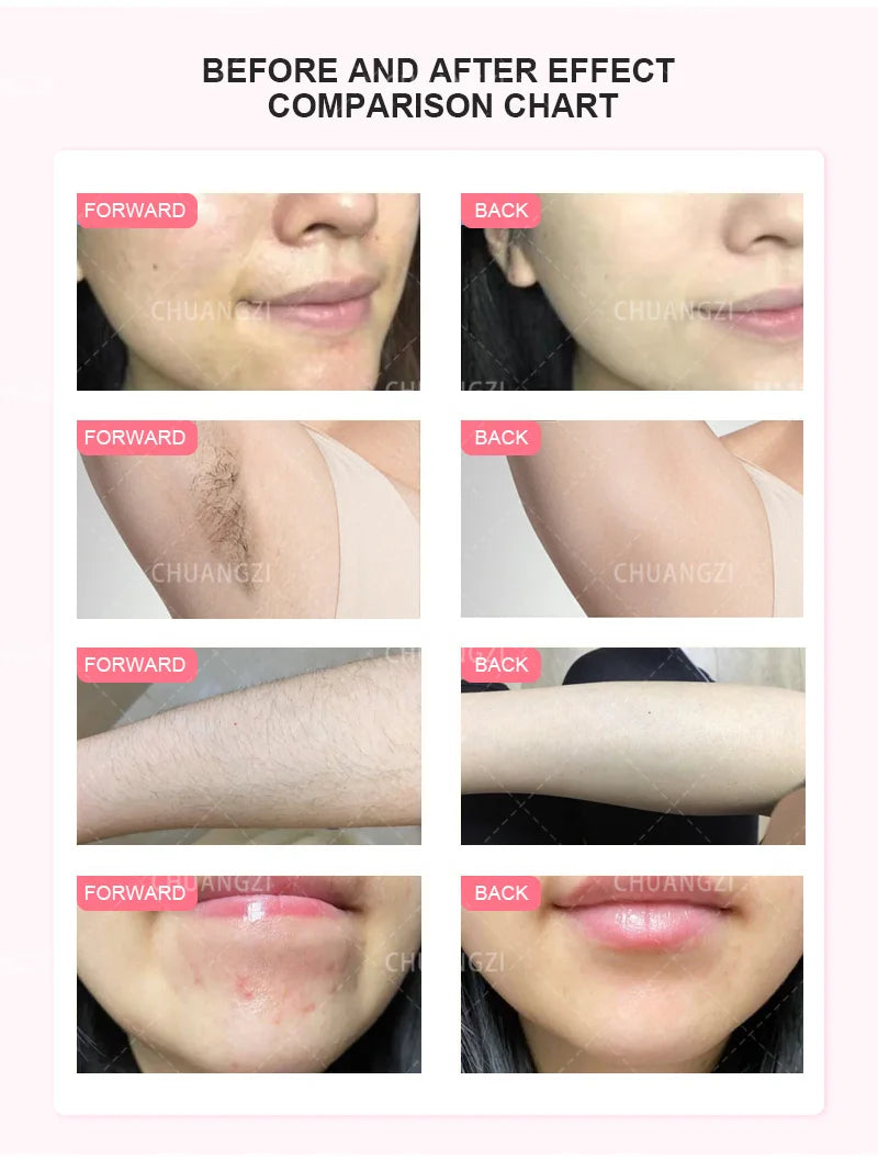 Beauty Salon 500000 Shots, Painless Laser, Permanent Hair Removal, Remove Color Spots Redblood Acne Photon Rejuvenation