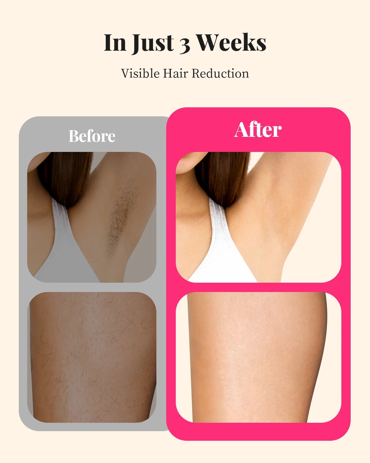 Painless Permanent Hair Removal, 990000 Flashes, Laser Hair Removal for Women and Men, IPL Hair Removal, Body Bikini and Facial Areas