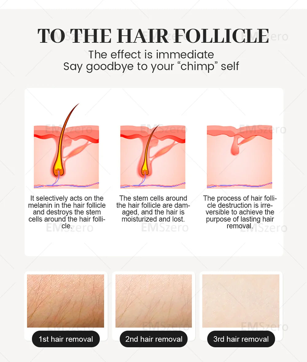 Diode Laser Hair Removal, Professional Machine, Painless Cooling, Permanent Lazer Hair Removal, 3 Wavelengths 755 808 1064